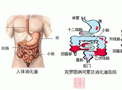 溃疡性结肠炎能吃牛肉吗