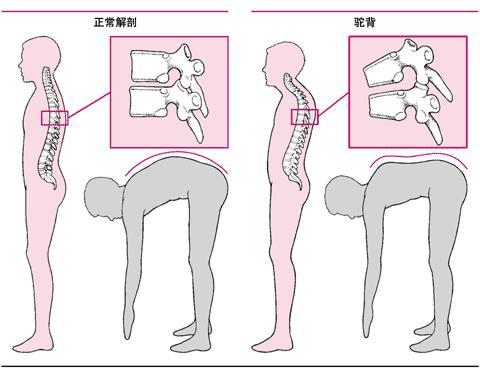 强直性脊柱炎乳房发炎