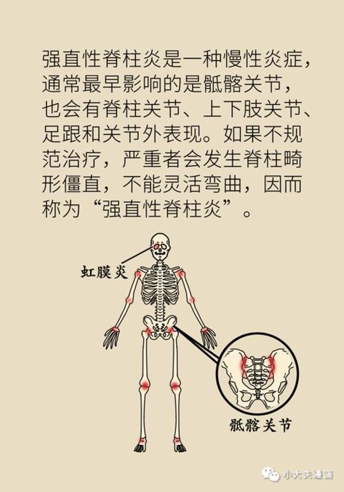 强直性脊柱炎和风湿有区别吗