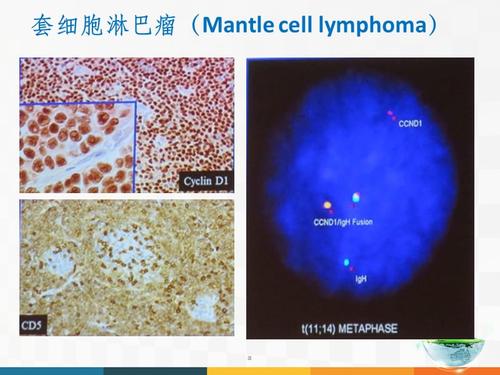 套细胞淋巴瘤