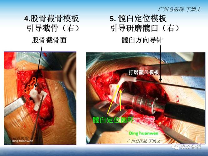 洋河医院骨科强直性脊柱炎