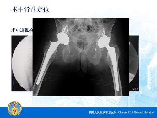 强直性脊柱炎髋关节痛