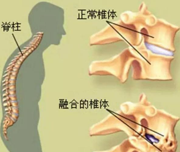 女友父亲强直性脊柱炎