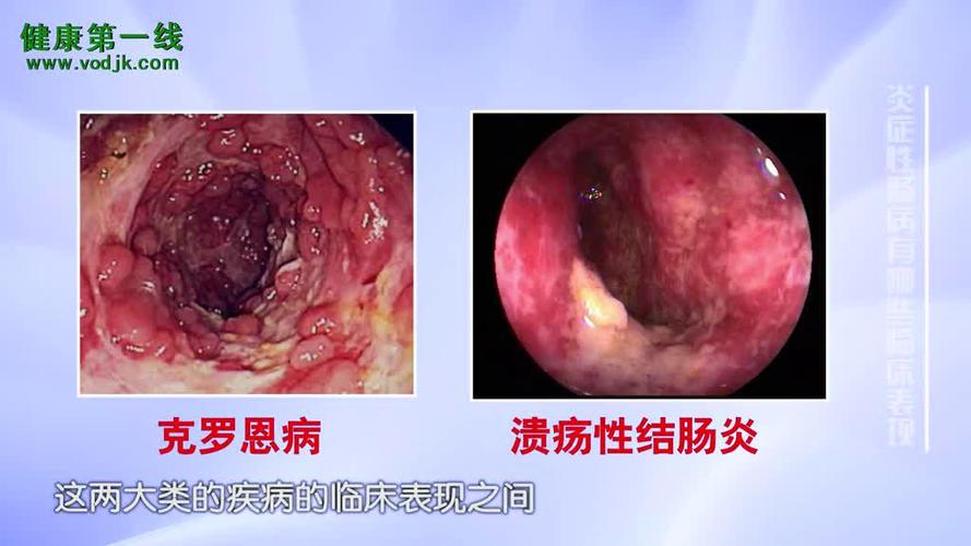 驴肠治溃疡性结肠炎