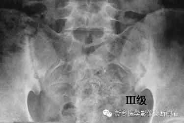 强直性脊柱炎查骶髂关节ct还是mri