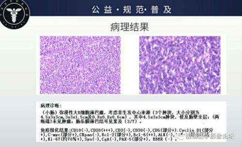 弥漫性大B细胞淋巴瘤