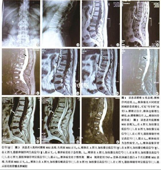 强直性脊柱炎的确诊