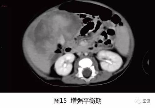 伯基特淋巴瘤