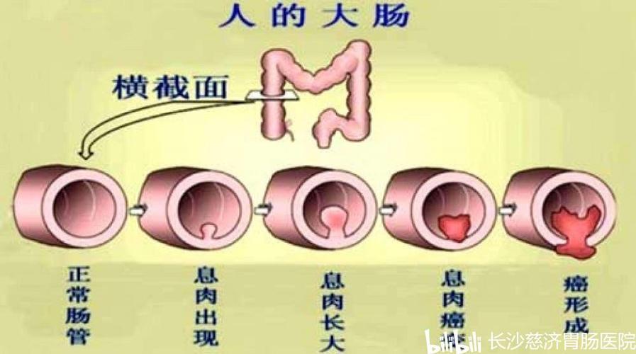 肠息肉和溃疡性结肠炎每天吃什么