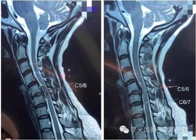 腰疼八个月是强直性脊柱炎吗