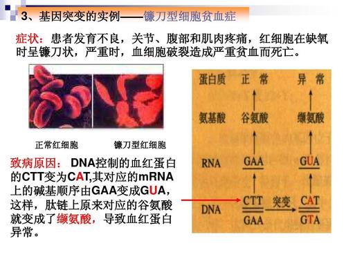 镰刀型细胞贫血病