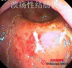 8年前做过肠镜溃疡性结肠炎