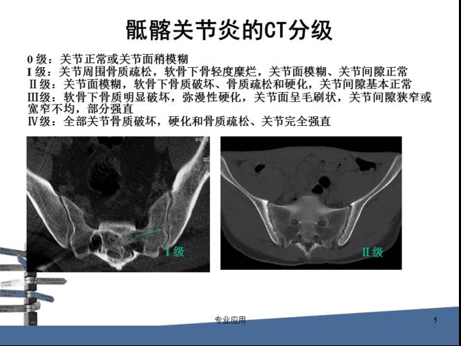 强直性脊柱炎肿瘤坏死