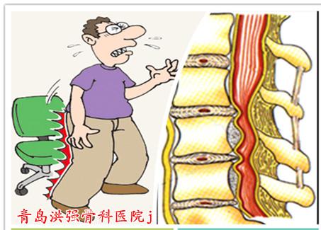 椎间管狭窄和强直性脊柱炎