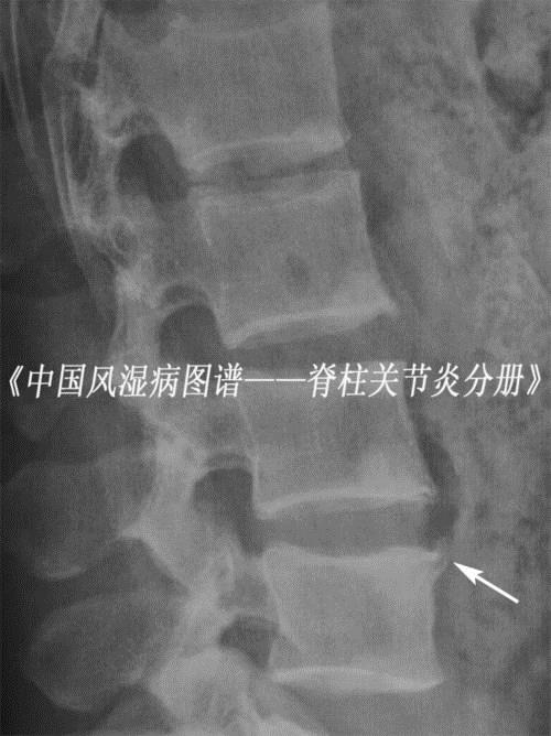 强直性脊柱炎骨头能长一块吗