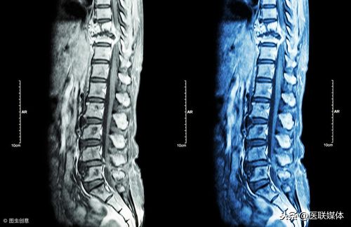 锥疗治好强直性脊柱炎