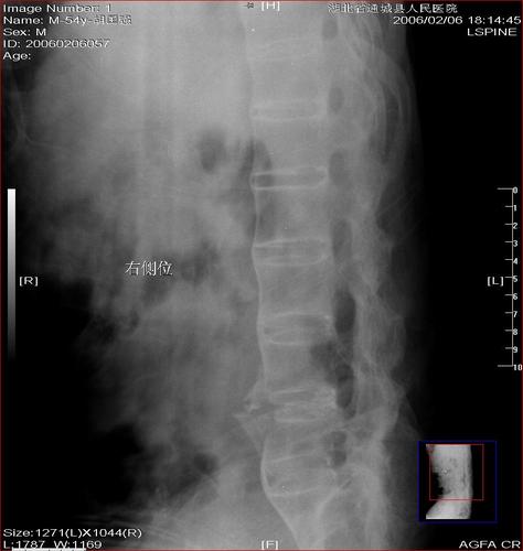 强直性脊柱炎x光