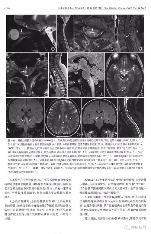 视神经脊髓炎