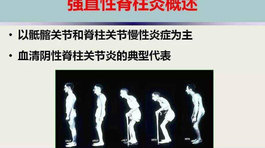 强直性脊柱炎和渐冻人哪个严重