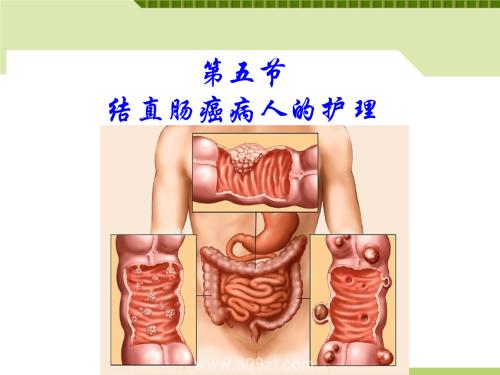 结直肠癌