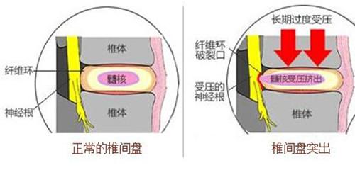 强直性脊柱炎引发腿疼怎么办