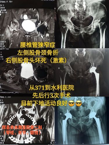 强直性脊柱炎人工关节置换风险