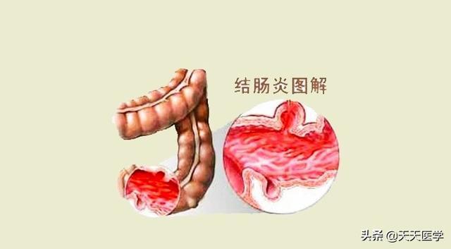 溃疡性结肠炎闹肚子吃啥补肚子