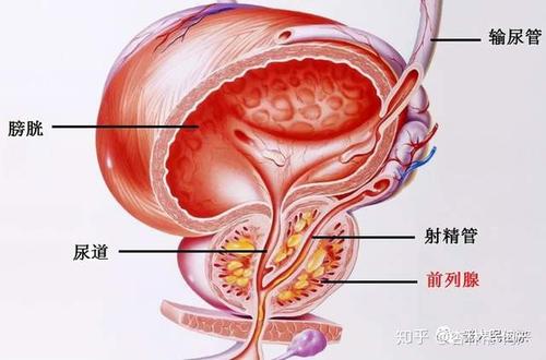 前列腺癌