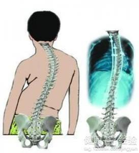强直性脊柱炎多少岁不再发展