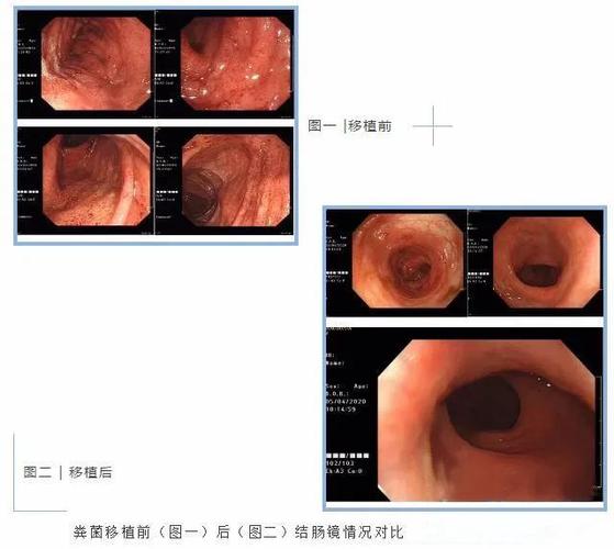 重度良性溃疡性结肠炎能治好吗