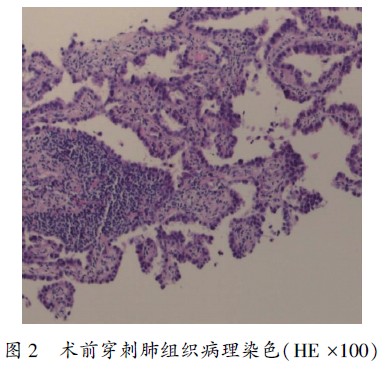 肺原位腺癌定义_吉非替尼能控制肺腺癌多久啊_肺鳞癌和腺癌哪种好治