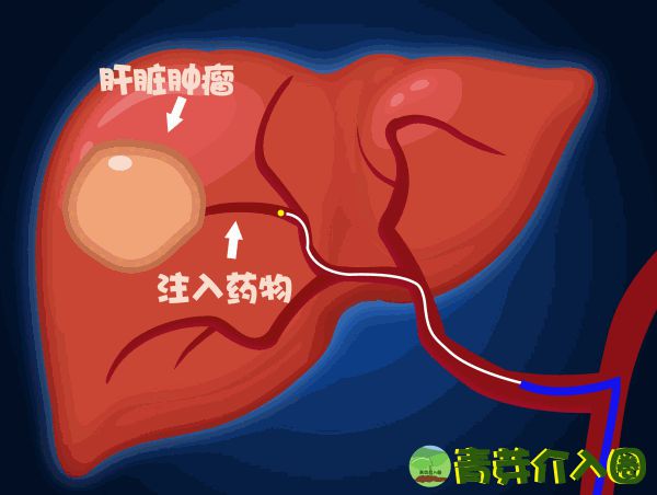 贝伐单抗适应症6_贝伐珠单抗_肺癌新药贝伐单抗