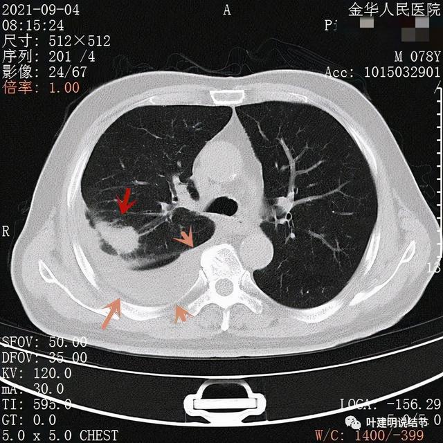 黑盒奥希替尼与原版效果比较_9291奥希替尼价格_奥希替尼多少钱一盒