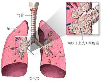 奥希替尼9291哪里买_肺癌晚期口服奥希替尼_甲磺酸奥希替尼片