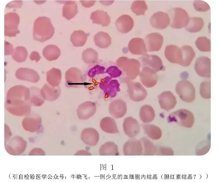 贝伐单抗耐药性_贝伐单抗对右半结肠癌效果_贝伐单抗能治好直肠癌