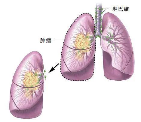 奥希替尼用药后一定要复查吗_奥希替尼印度版白盒_阿斯利康 奥希替尼