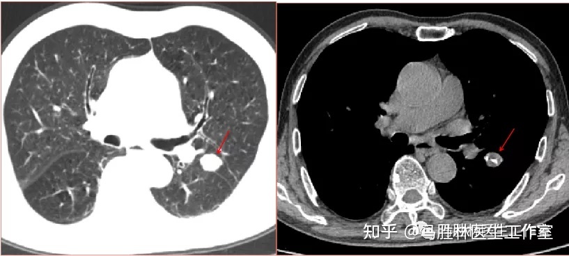 赛瑞替尼吃多久会耐药_香港买奥希替尼多少钱_吃奥希替尼耐药后会突变什么