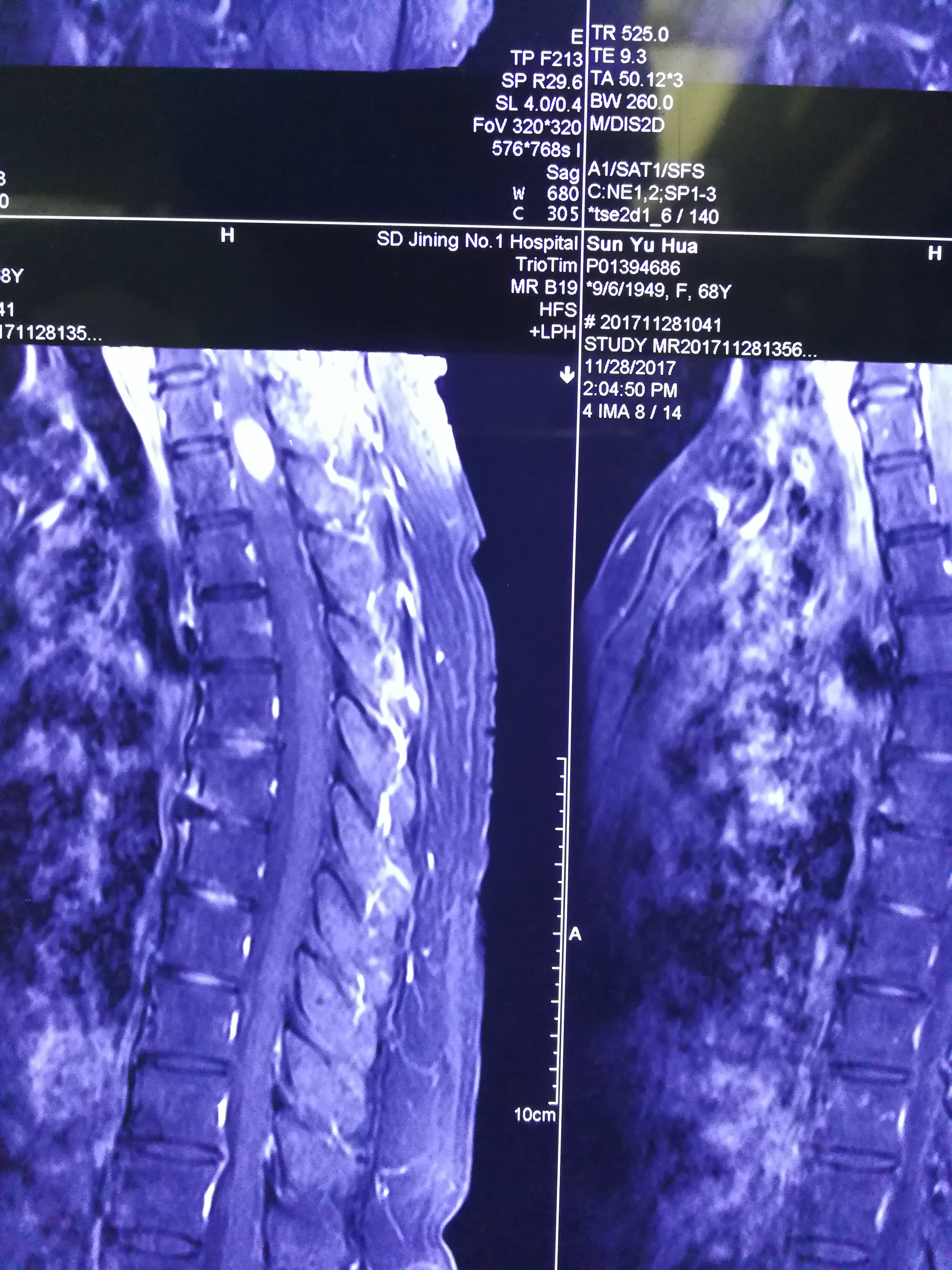 贝伐珠单抗注射液_贝伐珠单抗可以报销吗_进口贝伐珠单抗多少钱一支