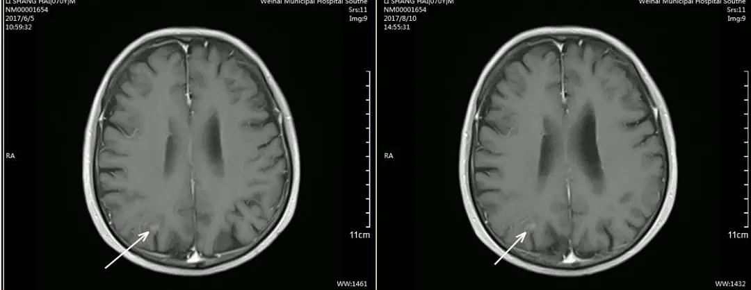 贝伐珠单抗治疗肺腺癌_贝伐珠单抗价格_贝伐珠单抗宫颈癌骨转移