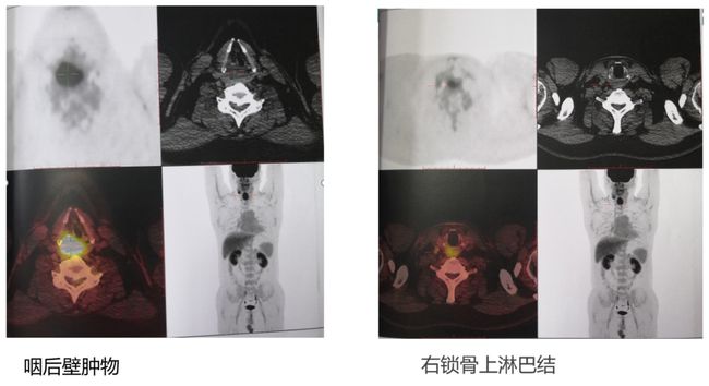 贝伐珠单抗最新价格_贝伐珠单抗是化疗药吗_贝伐珠单抗药效学