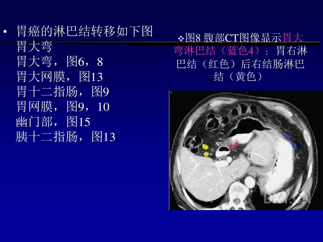 胃癌淋巴转移如何治疗_奥希替尼治疗腹腔淋巴转移吗_胃癌转移腹腔怎么治疗