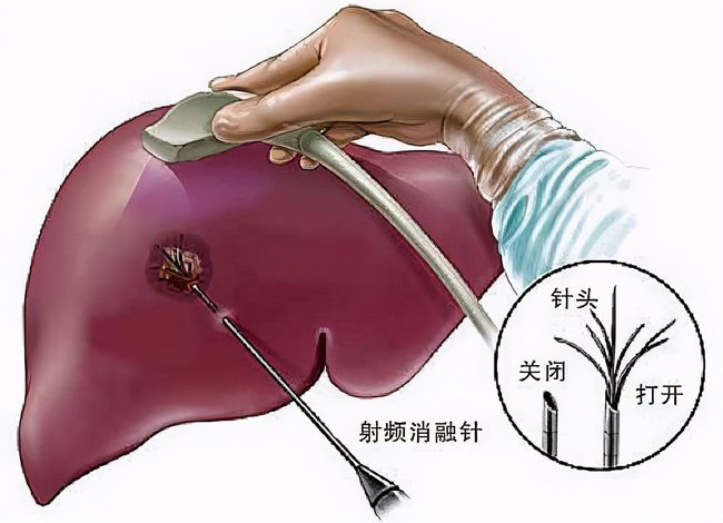 贝伐单抗耐药性_贝伐珠单抗是化疗药吗_贝伐单抗治疗卵巢癌症