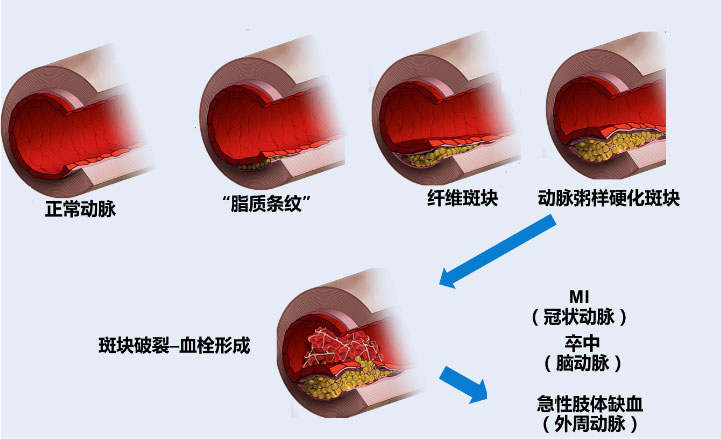 结肠癌晚期 贝伐珠单抗_贝伐珠单抗用多久后可以手术_贝伐珠单抗是化疗吗