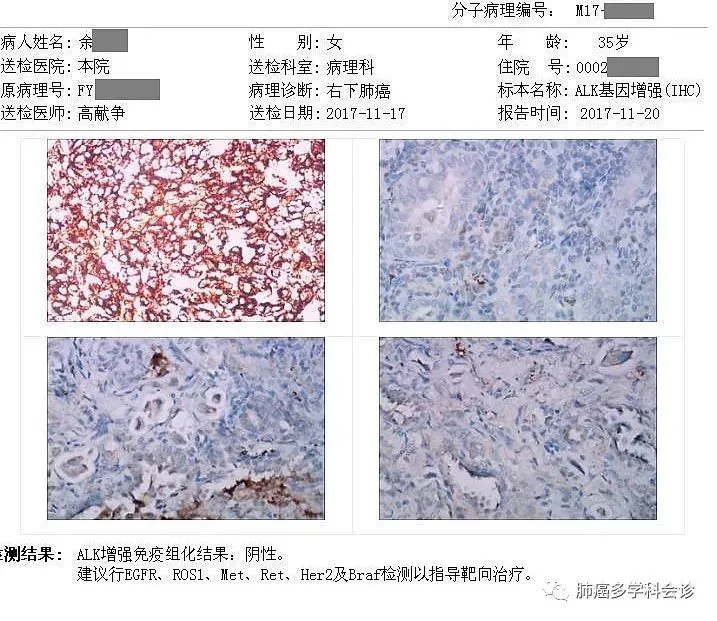 尼妥珠单抗联合化疗治疗胰腺癌的临床研究_贝伐珠单抗可以报销吗_贝伐单抗联合化疗