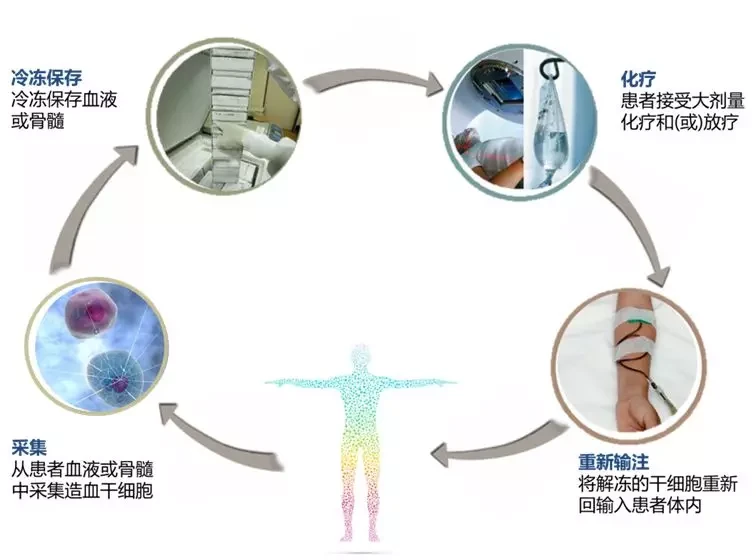 晚期肺鳞癌能治愈吗_晚期肺鳞癌吉非替尼_肺鳞癌晚期症状有哪些