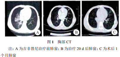 

肺腺癌晚期盲试吉非替尼有没有有没有效果效果？