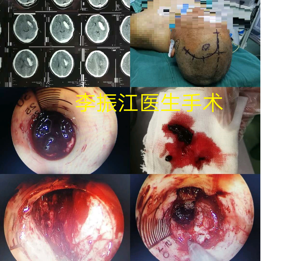 贝伐珠单抗注射液的商品名_贝伐珠单抗是靶向药吗_贝伐珠单抗多少钱一只