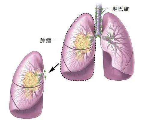 肺癌吃奥希替尼身体颤抖_奥希替尼印度版多少钱_甲磺酸奥希替尼片