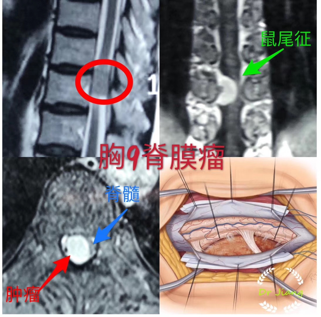 贝伐单抗靶向药用法_贝伐单抗为什么赠药_贝伐珠单抗是什么药