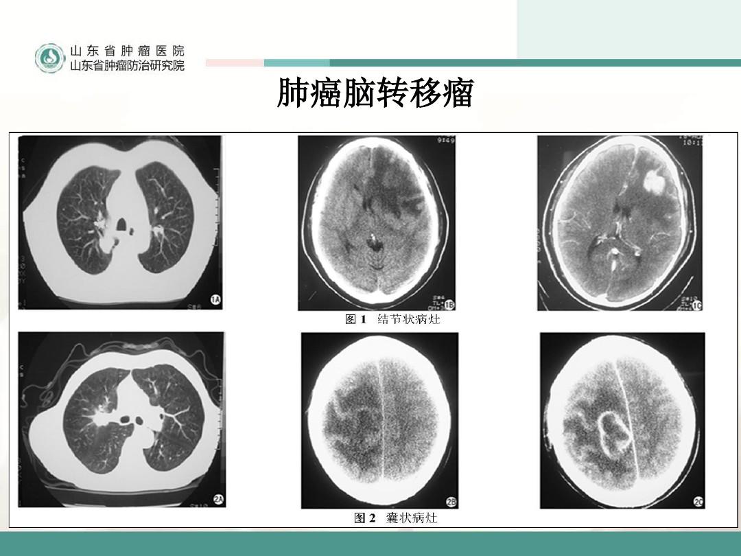 奥斯替尼和奥希替尼_克唑替尼耐药后alk阳性_奥希替尼耐药后有新药了吗